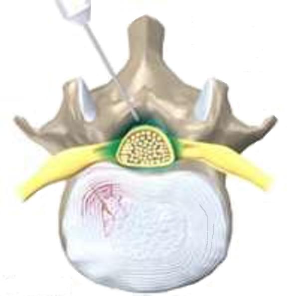 epidural 2