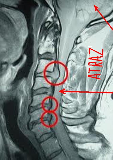 herniated disc 11