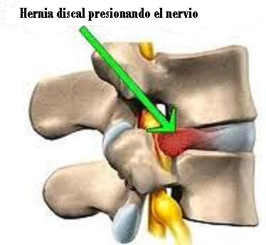 herniated disc 2