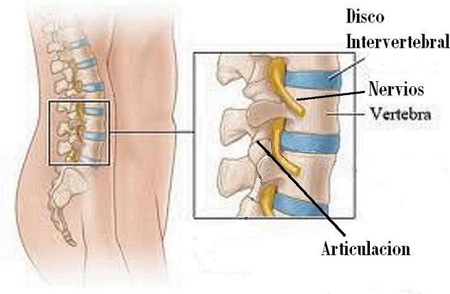 herniated disc 3