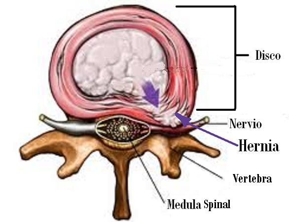 herniated disc 7