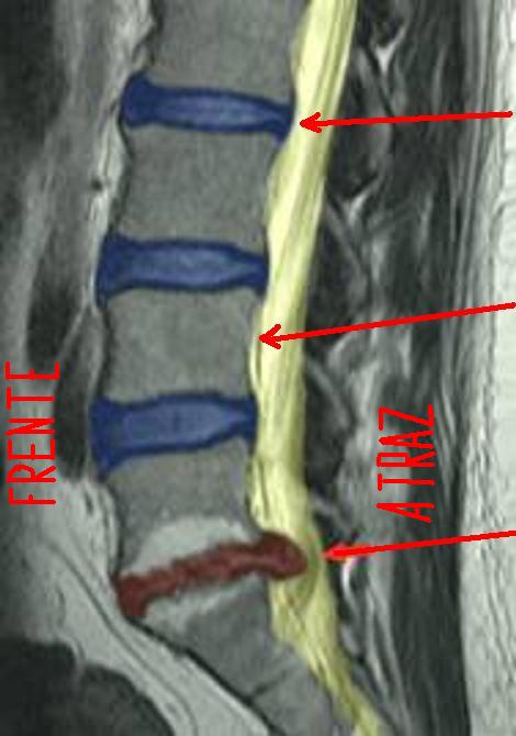 herniated disc 8