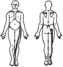 radiculopathy